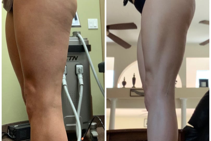 Side-by-side comparison of a person's thigh before and after muscle toning or treatment.